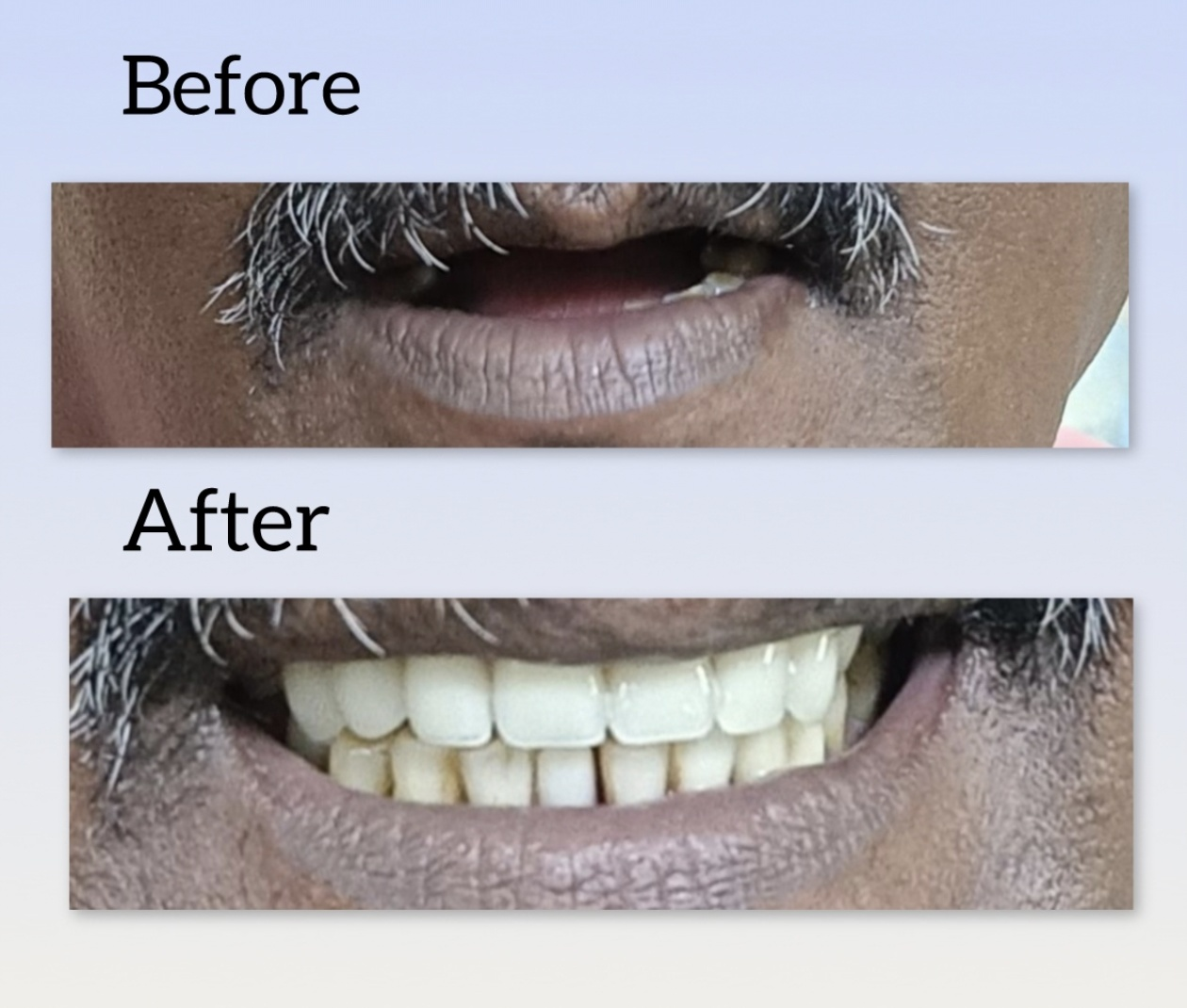 Complete Denture Treatment