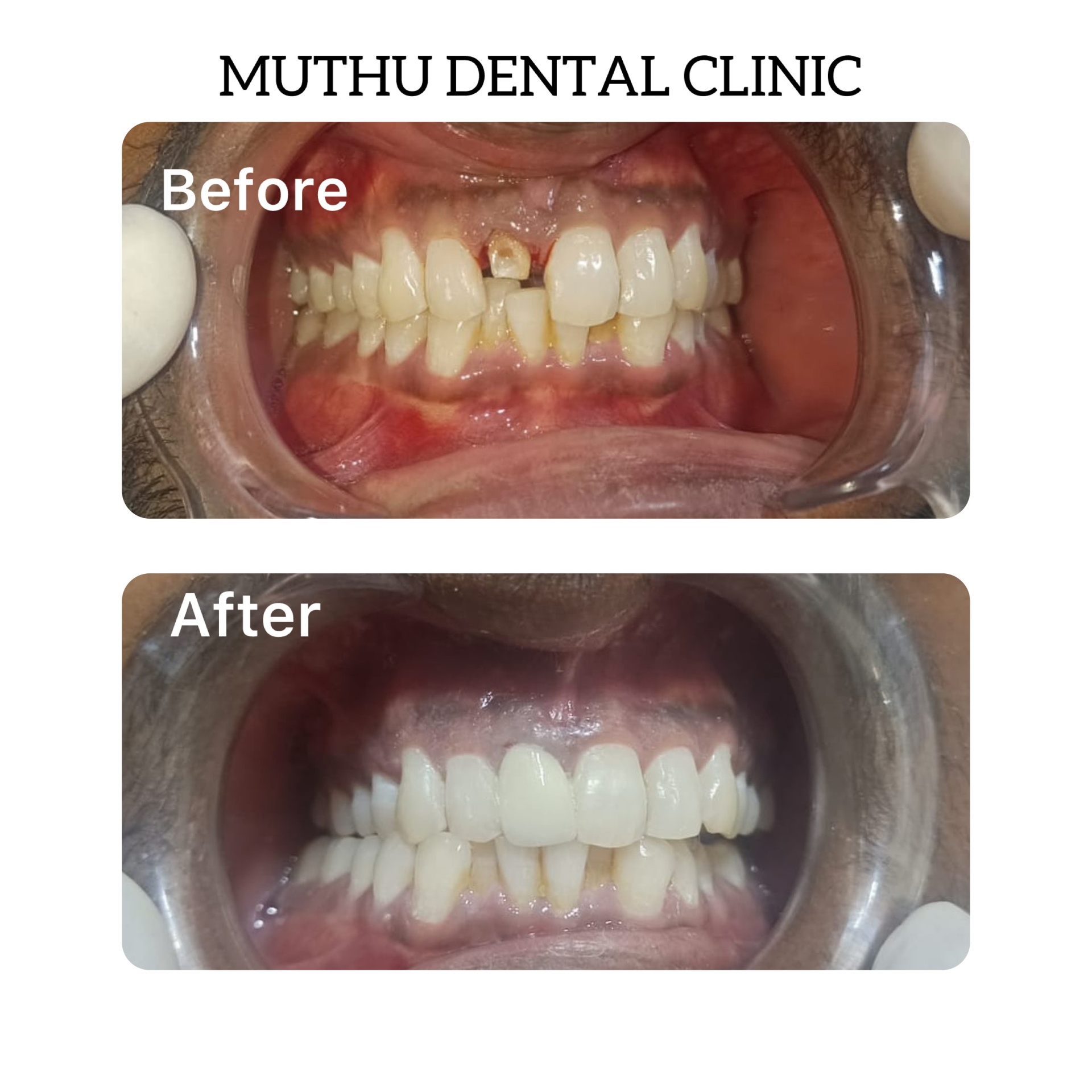 Smile transformation — before and after dental treatment at Muthu Dental Clinic