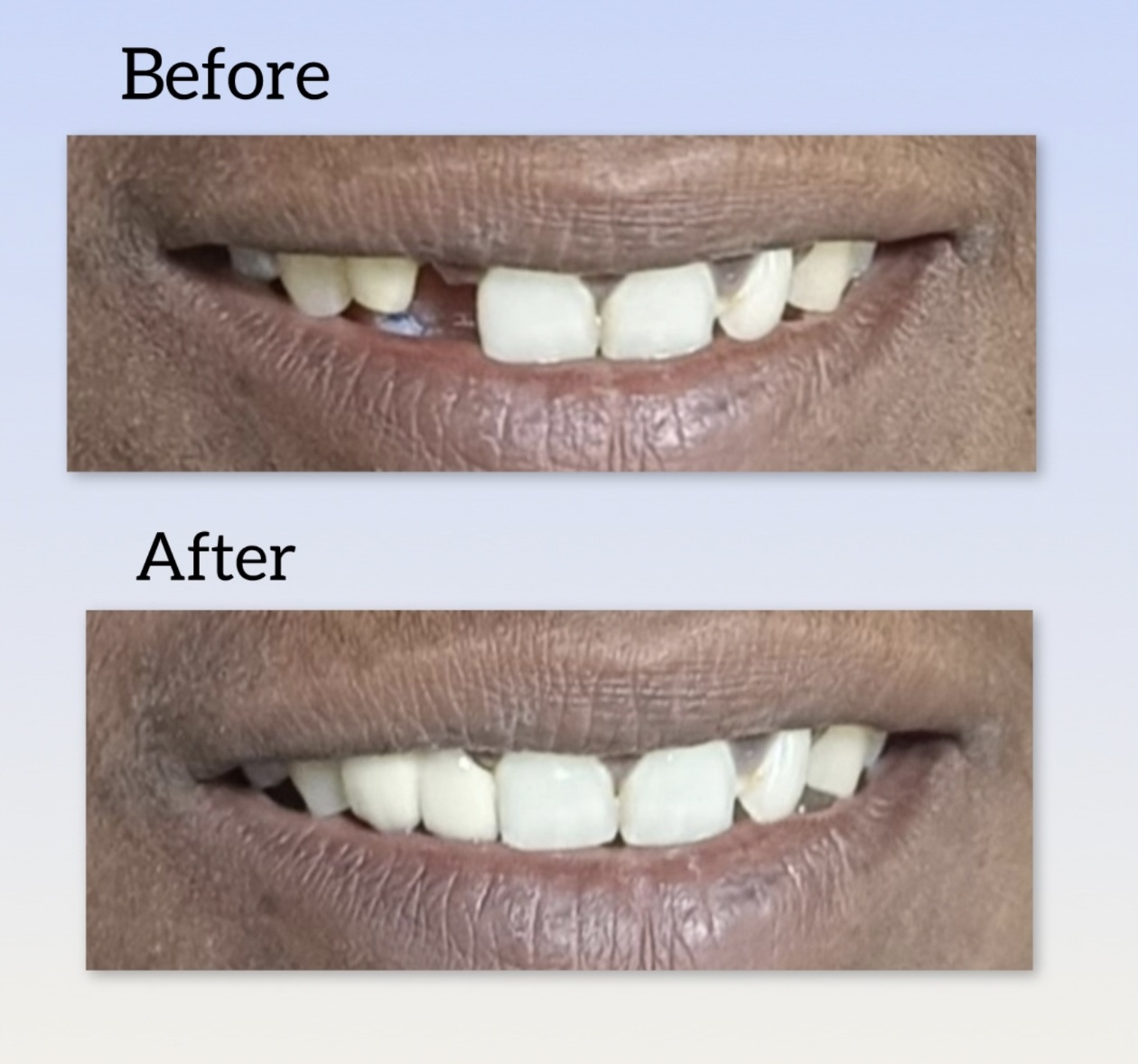 Smile Makeover